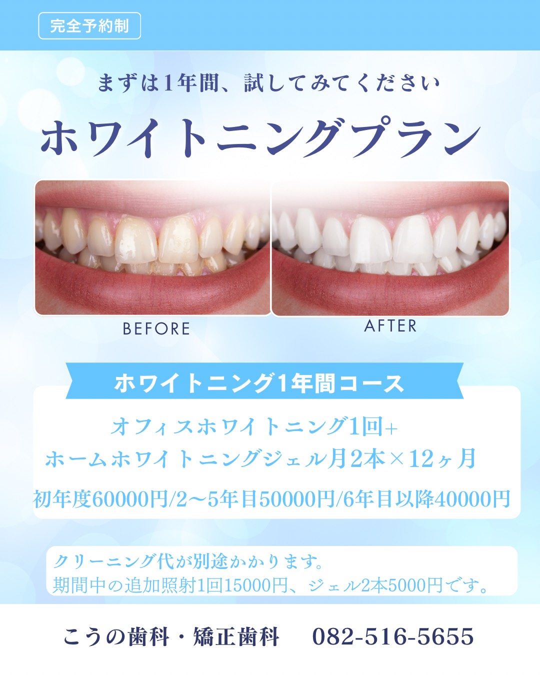 1年間のホワイトニングプランのご案内【広島の歯医者 こうの歯科・矯正歯科】