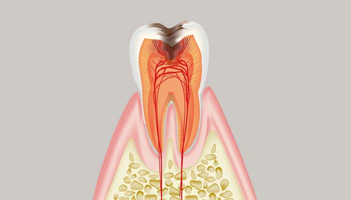 C3：神経（歯髄）に達した虫歯